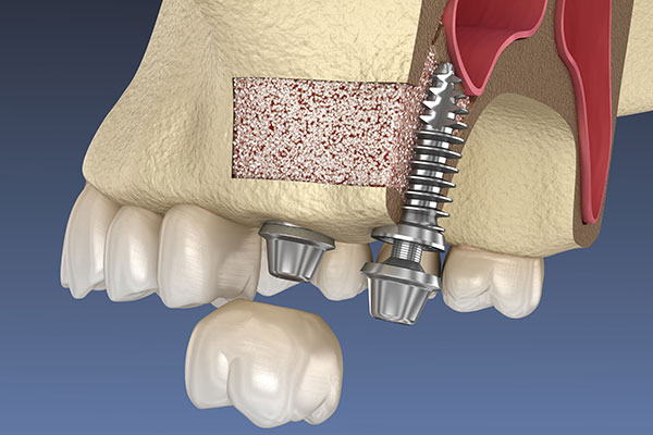 Reidge preservation rendering at Periodontal Surgical Arts.