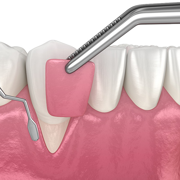 Soft Tissue Grafting daigram at Periodontal Surgical Arts.