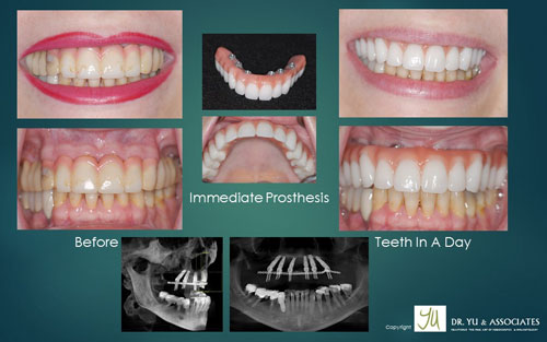 Case study of all on 4 implants