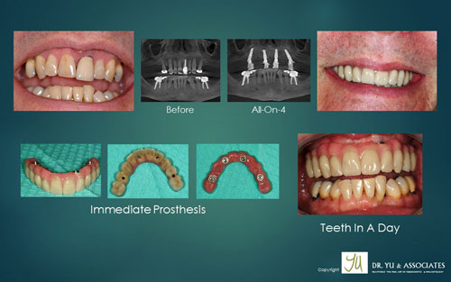 Case study of all on 4 implants