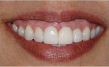 After picture of a smile of a patient with smile restored.