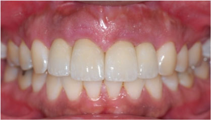 After picture of a smile of a patient with smile restored.