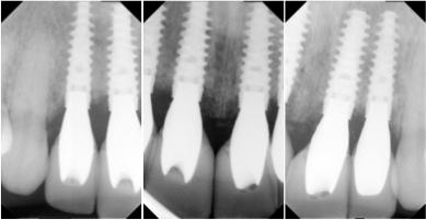 After picture of a smile of a patient with smile restored.