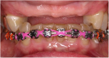 An image of orthodontic work, where space was created for implants.