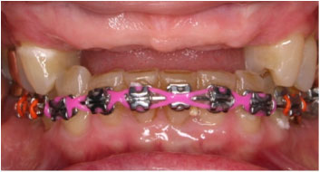 An image of orthodontic work, where space was created for implants.