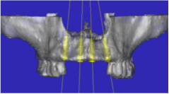 CT planning and guided surgery preparations