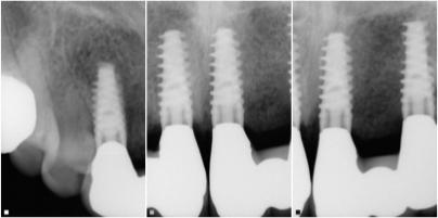 After image of the smile with implant-supported restorations function that feel, and look natural