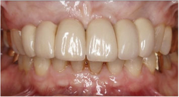 After image of the smile with implant-supported restorations function that feel, and look natural