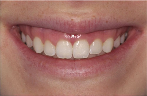 BEFORE: Teeth are square-shaped.