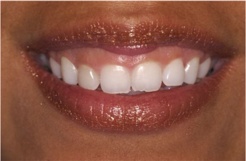 BEFORE: Gum levels create the shape of the teeth.