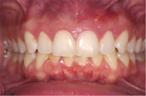 AFTER: A combination of gum grafting and crown lengthening.