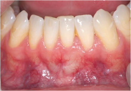 AFTER: After grafting, the tissues are reconstructed.