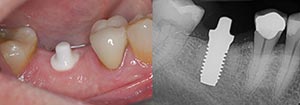 An image of Zicornia implant base placed in gums with x-ray of that cross section at Periodontal Surgical Arts in Austin, TX