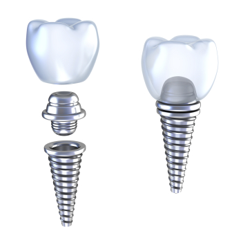 Dental implant diagram of implants being attached together at Periodontal Surgical Arts in Austin, TX Dental implant diagram of implants being attached together at Periodontal Surgical Arts in Austin, TX