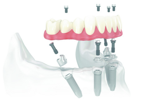 Computer rendering of the All On 4 Treatment Concept technique at Periodontal Surgical Arts in Austin, TX