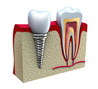 3D model of a cross section of dental implant tooth and normal tooth at Periodontal Surgical Arts in Austin, TX
